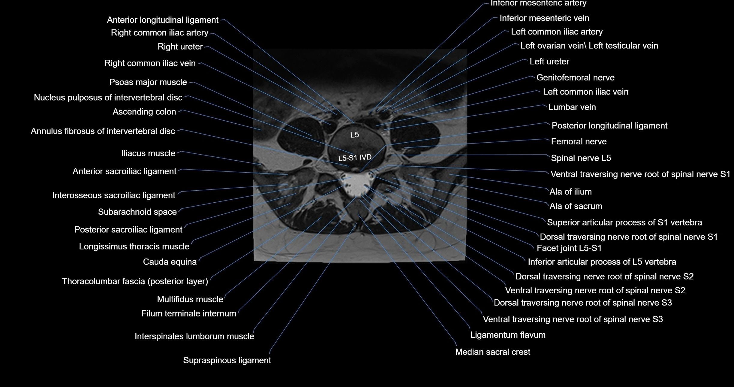 MRI lumbar spine axial cross sectional anatomy 3T radiology  image-img-00001-00041.webp